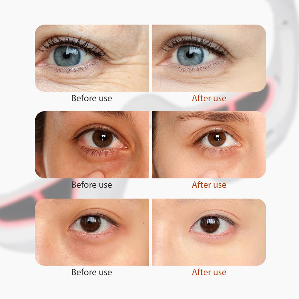 🖐️Eye Massager With Red Light For Under Eye Swelling And Fine Lines